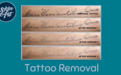 Tattoo Removal Training Course