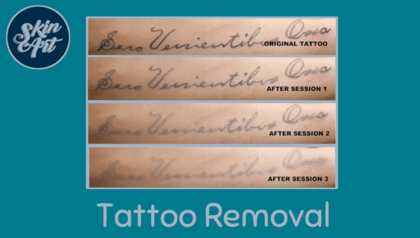 Online Tattoo Removal Course