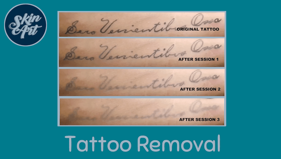 Tattoo removal in Pimville - Booksy
