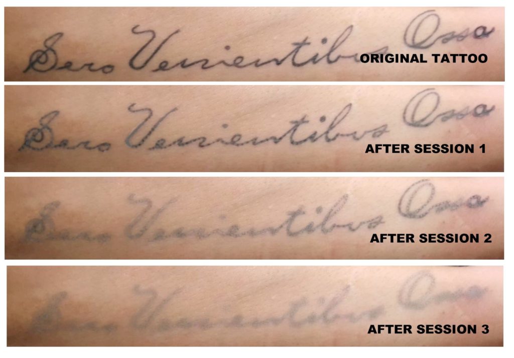 Tattoo Removal Course